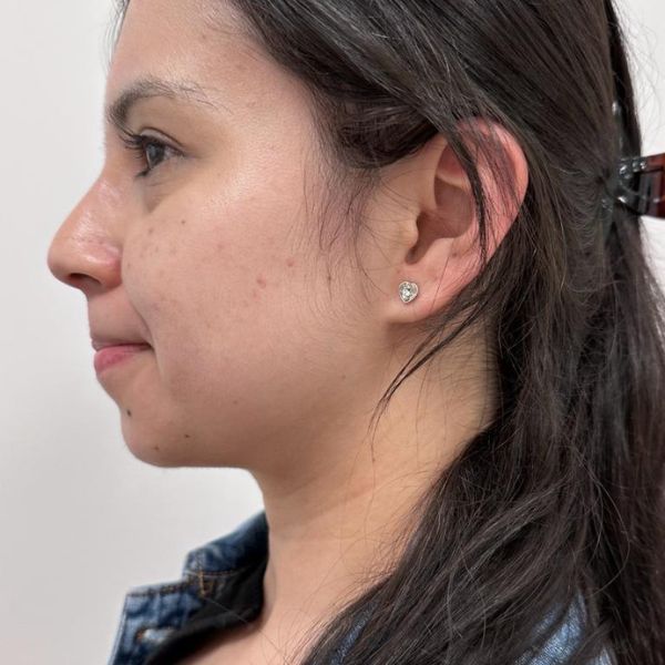 lipo papada antes